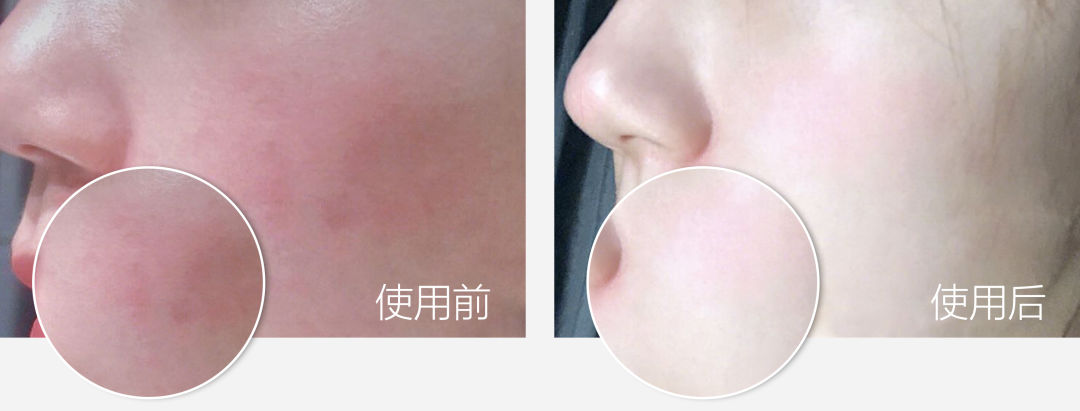 蚊虫叮咬湿疹止痒哪种药膏好用,晒伤后两天奇痒止痒最佳办法