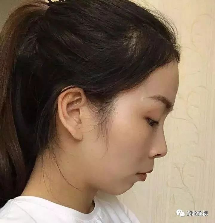 推广|身份证42开头的注意!牙齿矫正、种植牙,这些全免费!