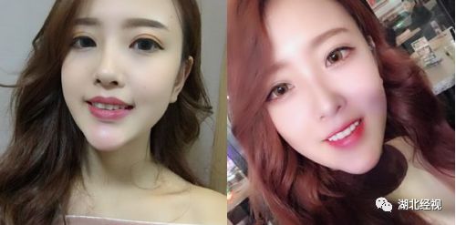 推广|身份证42开头的注意!牙齿矫正、种植牙,这些全免费!