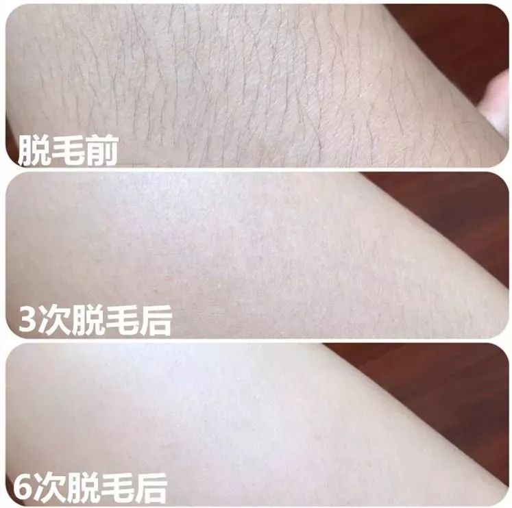 现在最好的脱毛产品,夏季脱毛都什么价位