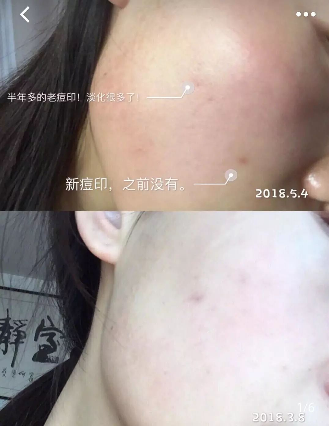 疤痕体质如何去痘印和烫伤印,烫伤色素疤痕修复的最新方法