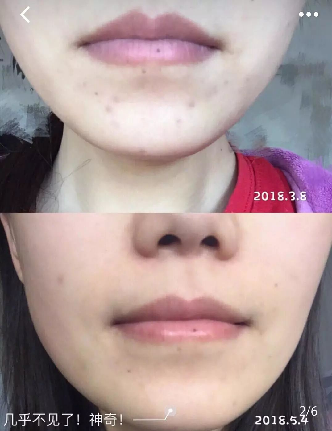 疤痕体质如何去痘印和烫伤印,烫伤色素疤痕修复的最新方法