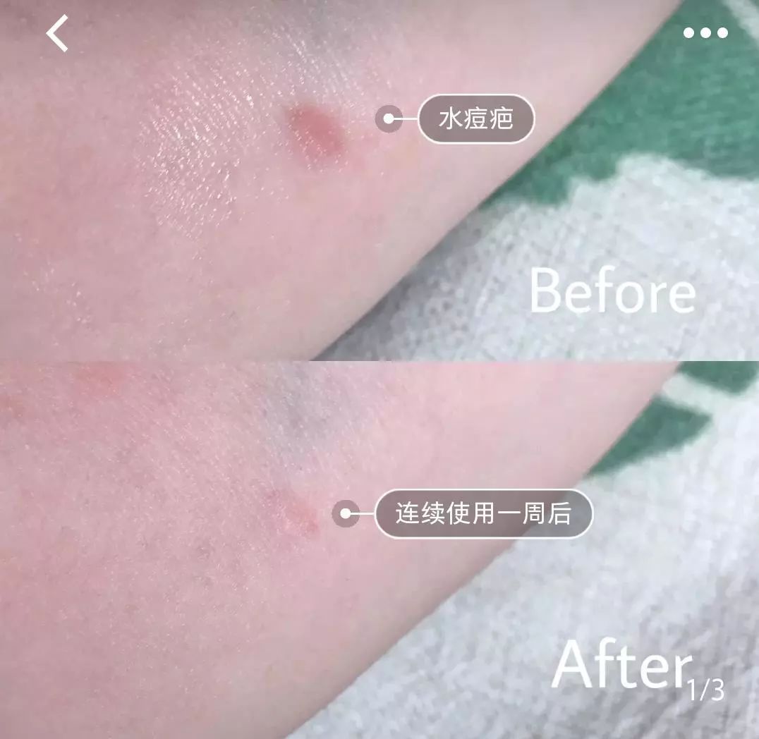 疤痕体质如何去痘印和烫伤印,烫伤色素疤痕修复的最新方法