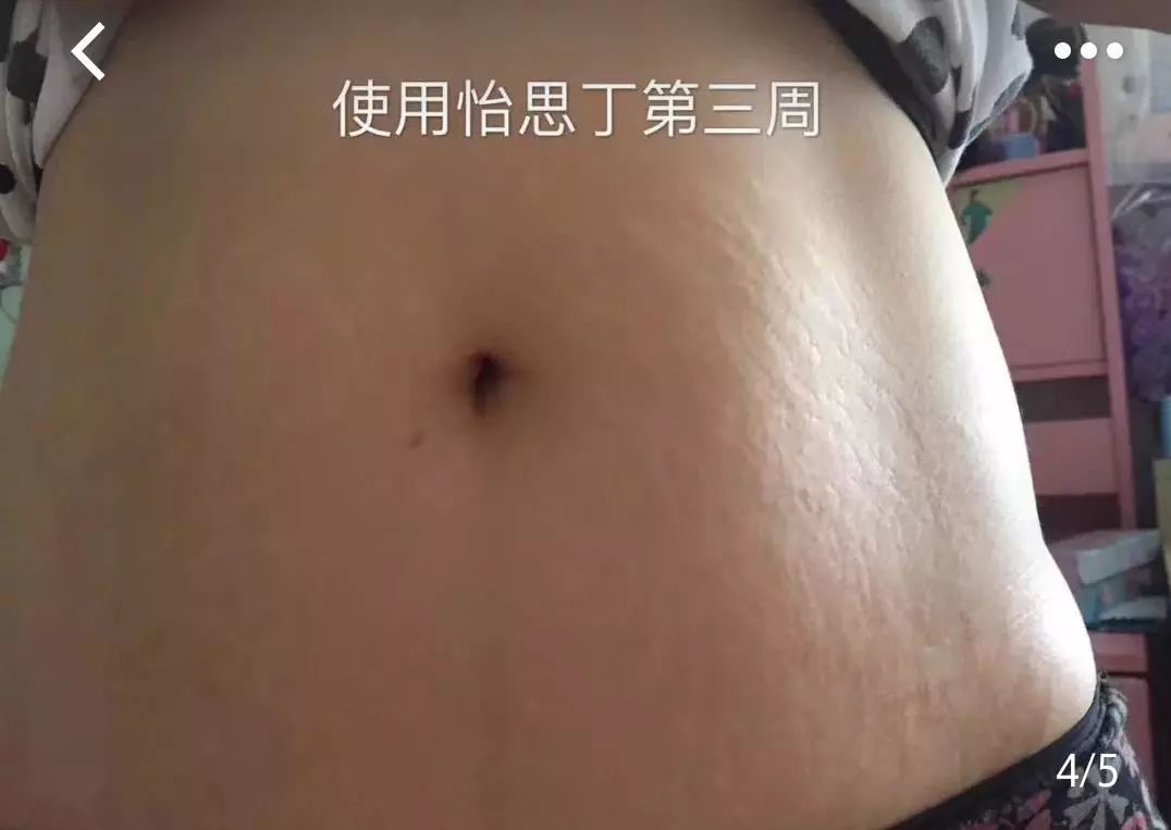 疤痕体质如何去痘印和烫伤印,烫伤色素疤痕修复的最新方法