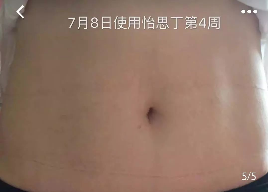 疤痕体质如何去痘印和烫伤印,烫伤色素疤痕修复的最新方法