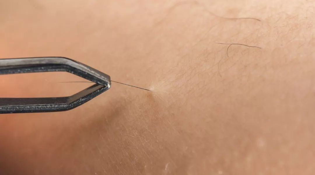 女生长胡子怎么办彻底去除,女生长胡子怎么治呢