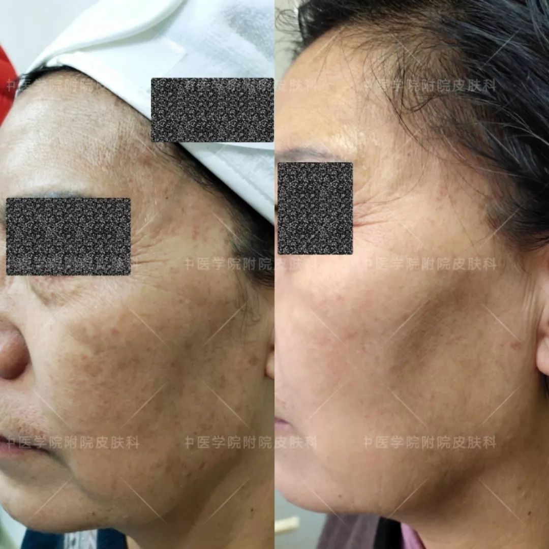 光子嫩肤优惠活动,医院光子嫩肤打特价