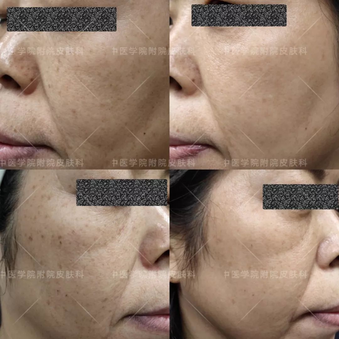 光子嫩肤优惠活动,医院光子嫩肤打特价