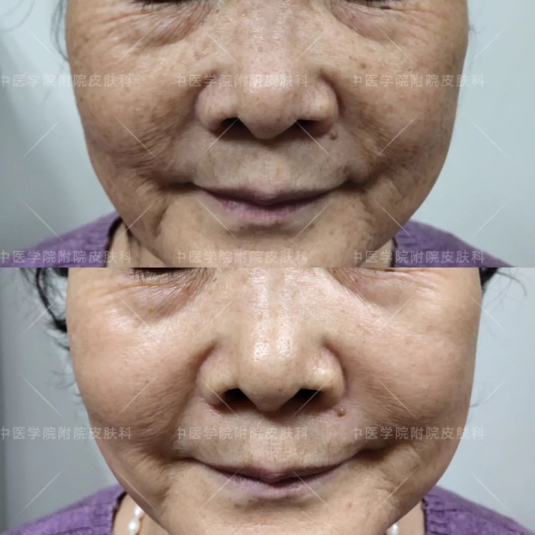 光子嫩肤优惠活动,医院光子嫩肤打特价