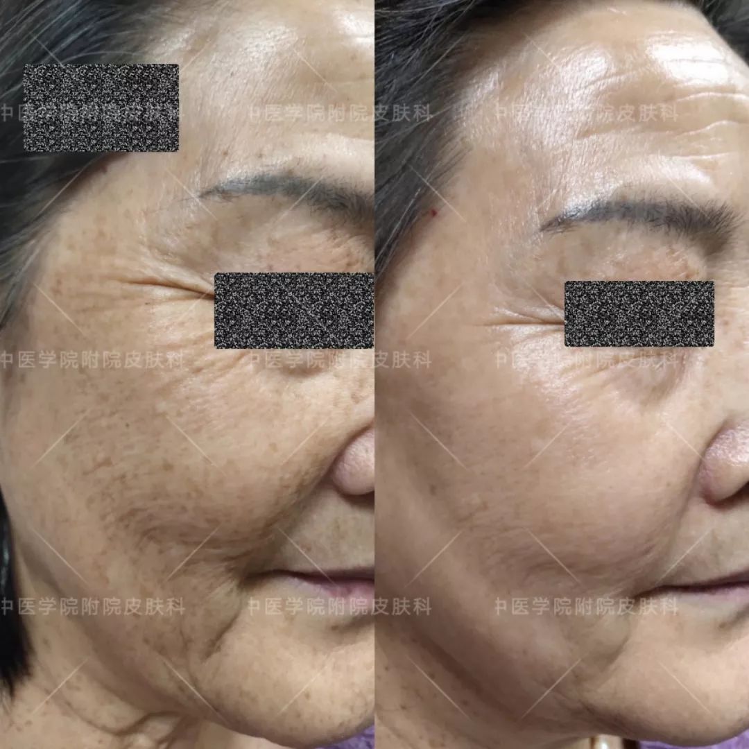 光子嫩肤优惠活动,医院光子嫩肤打特价