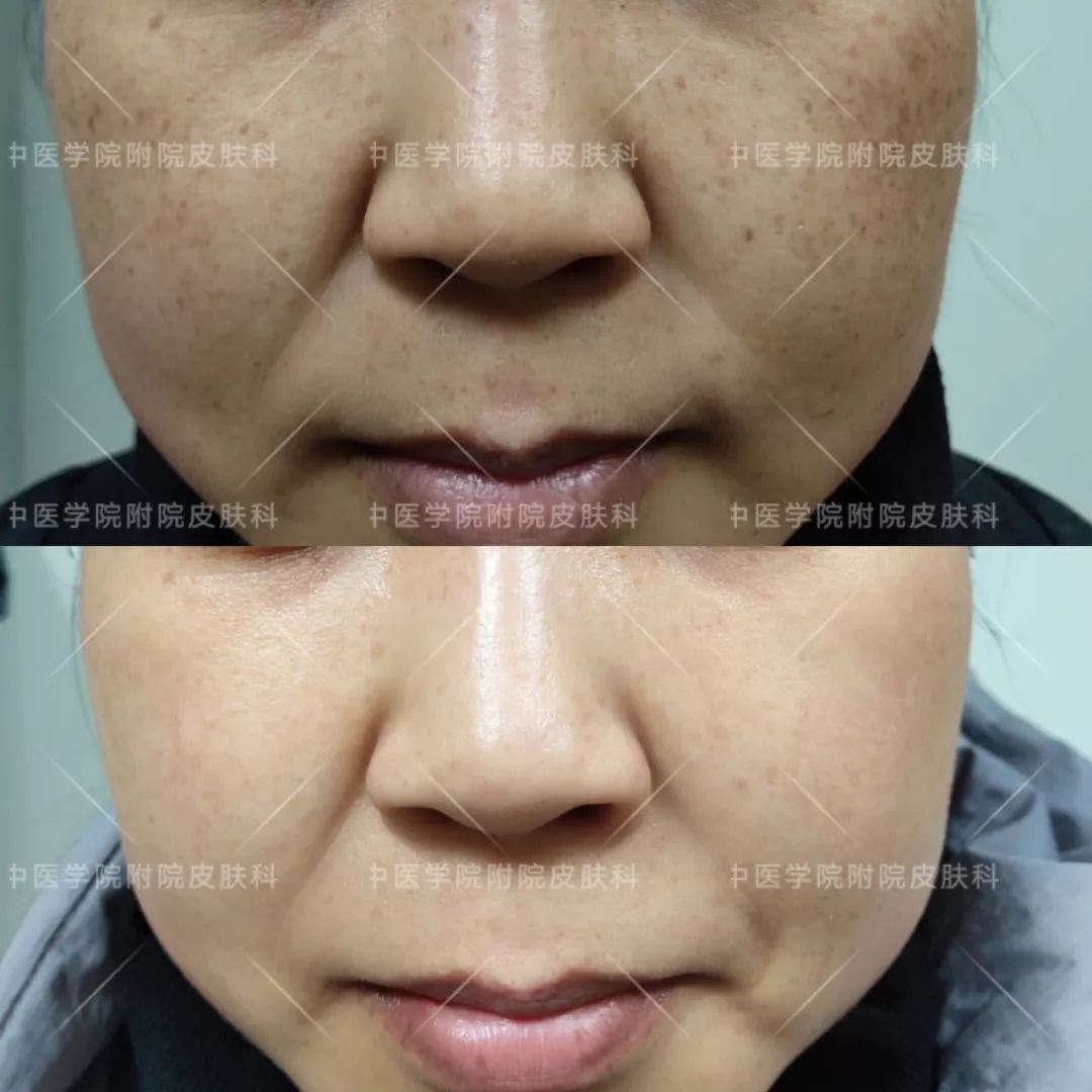 光子嫩肤优惠活动,医院光子嫩肤打特价