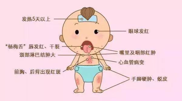 不完全川崎病和完全川崎病,川崎病为啥叫川崎病