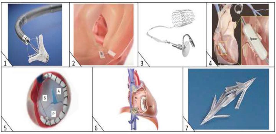 经导管瓣膜修复术费用,经导管介入治疗先天性心脏病