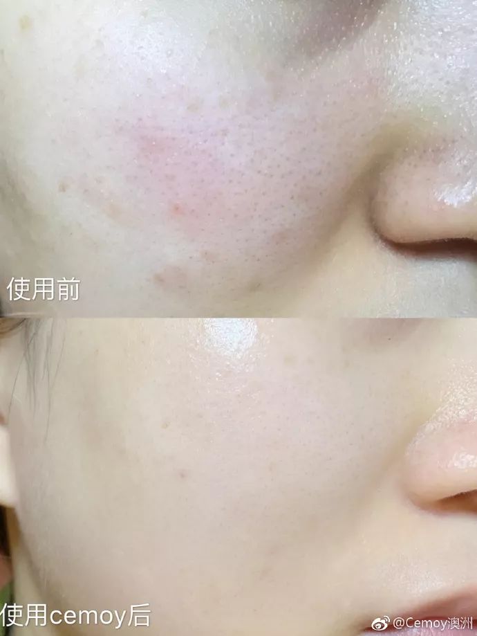 张嘉倪同款月光宝盒精华液,张嘉倪给人涂保湿美白精华液