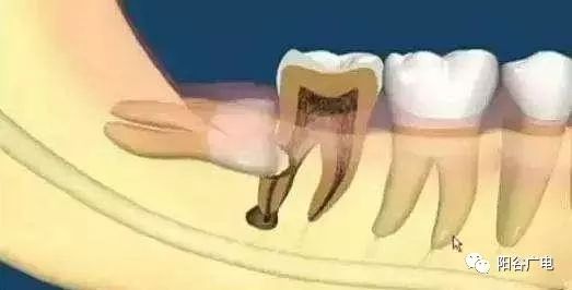 上面智齿磨下牙床肿了怎么办,上火智齿旁边的肉肿了怎么办