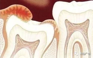 上面智齿磨下牙床肿了怎么办,上火智齿旁边的肉肿了怎么办