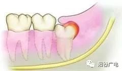 上面智齿磨下牙床肿了怎么办,上火智齿旁边的肉肿了怎么办