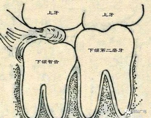 上面智齿磨下牙床肿了怎么办,上火智齿旁边的肉肿了怎么办