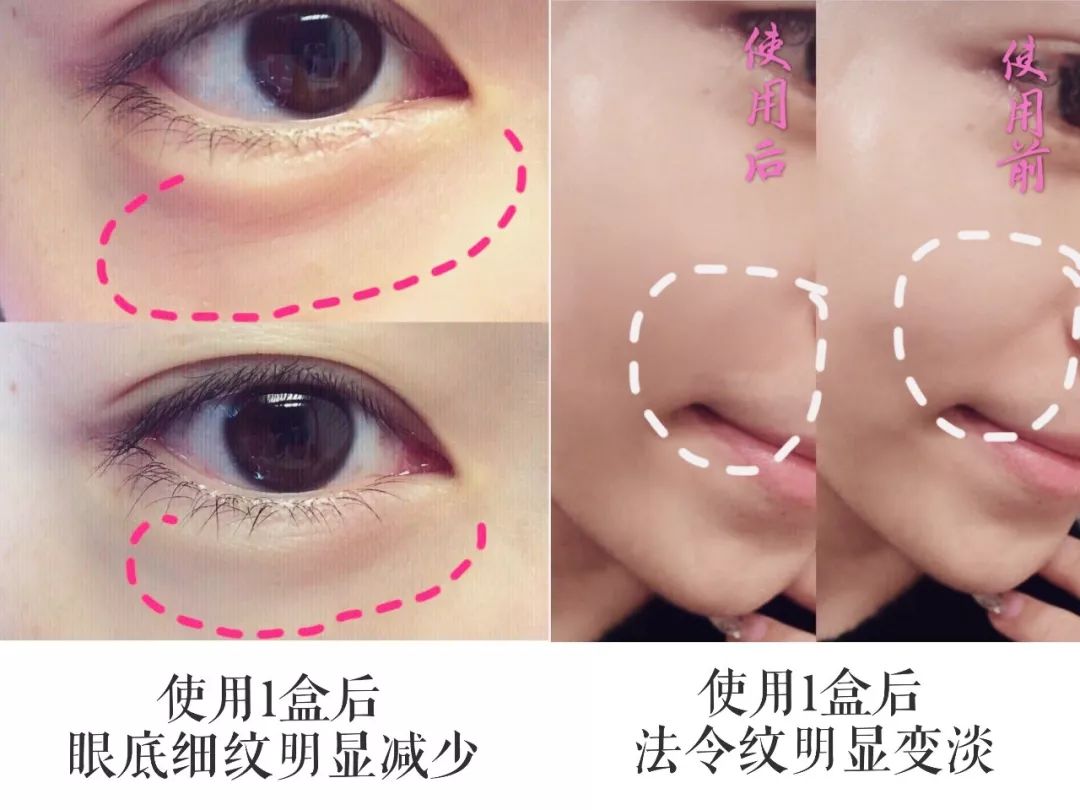 玻尿酸冻干眼纹贴,法令纹用一支玻尿酸够了没有