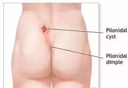 男生熬夜长出小尾巴,一男子连续熬夜长出毛尾巴