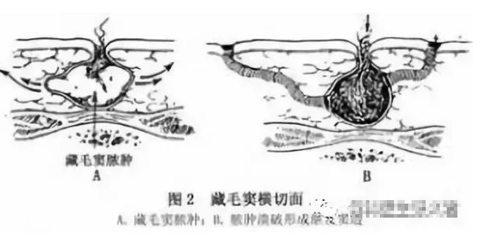男生熬夜长出小尾巴,一男子连续熬夜长出毛尾巴
