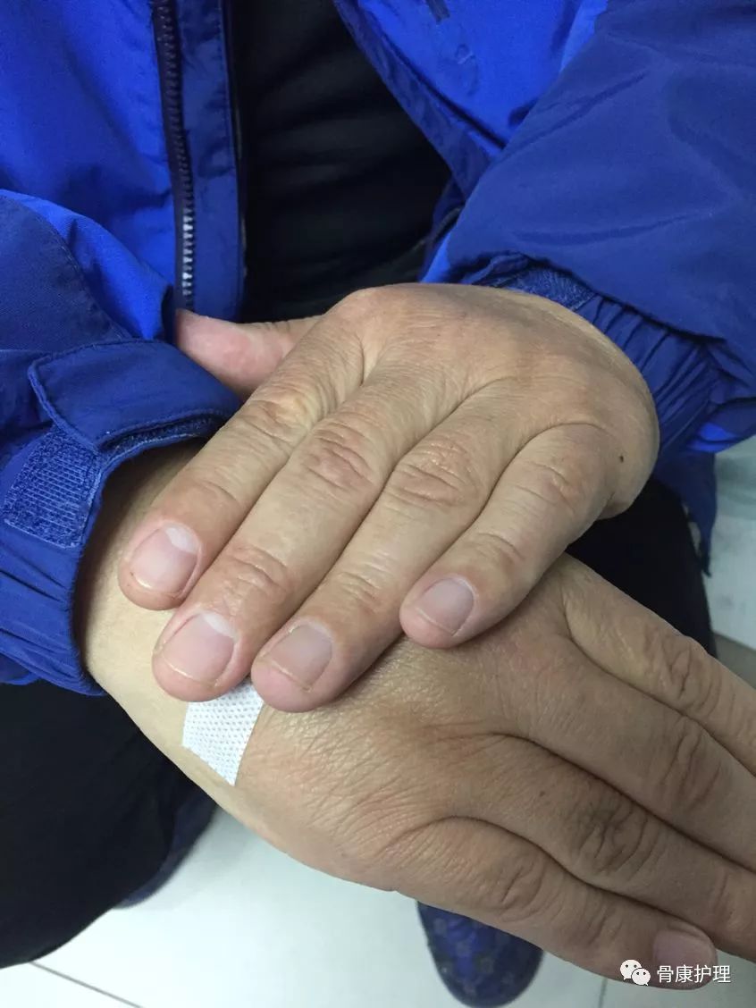 打吊瓶手青了怎么迅速消除,打吊瓶手青了怎么消除