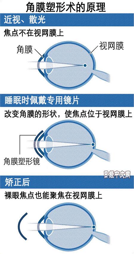 角膜塑形可以治疗近视么,日本角膜手术治疗近视眼