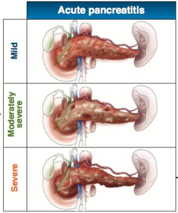 急性胰腺炎精华总结，值得一看！