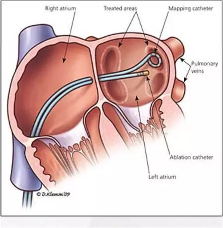 专家讲房颤治疗方法,专家医生谈房颤