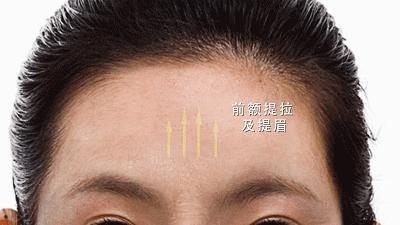 抬头纹法令纹鱼尾纹克星能管用吗,抬头纹鱼尾纹法令纹均可改善