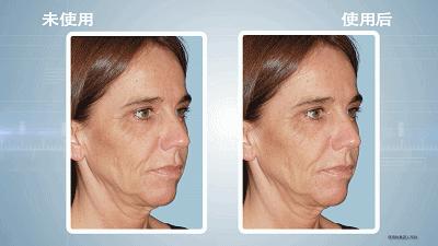 抬头纹法令纹鱼尾纹克星能管用吗,抬头纹鱼尾纹法令纹均可改善
