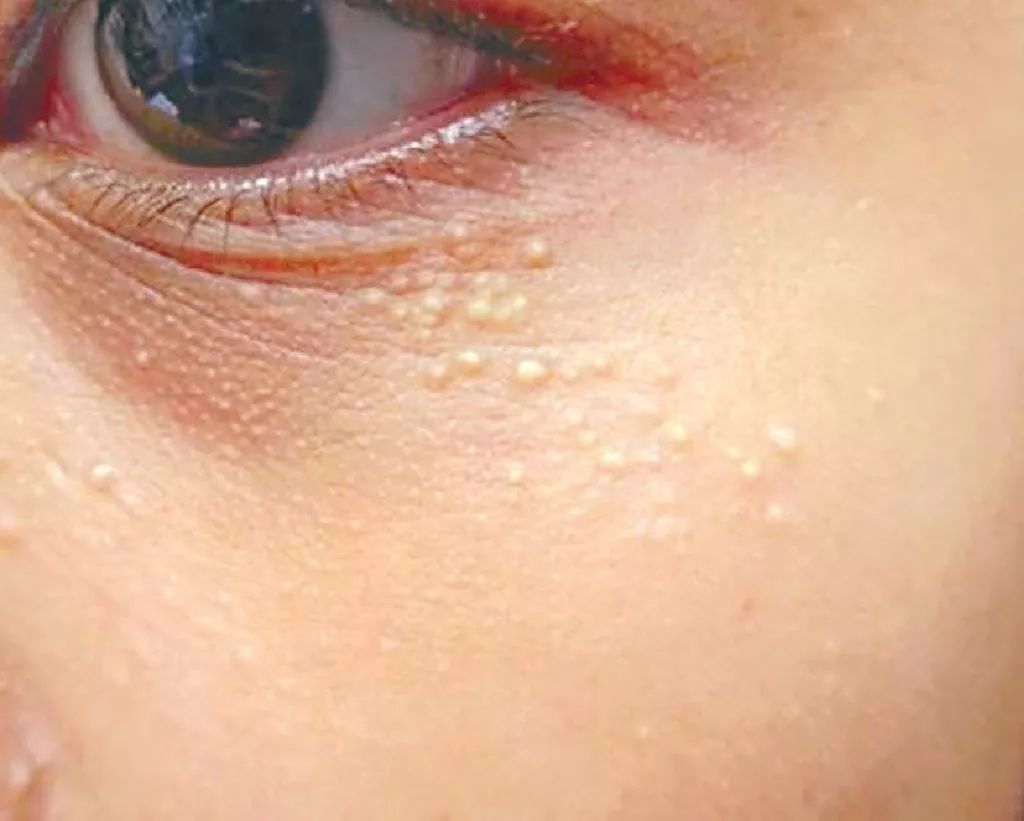 涂眼霜会引起汗管瘤吗,涂眼霜会引起眼部斑吗