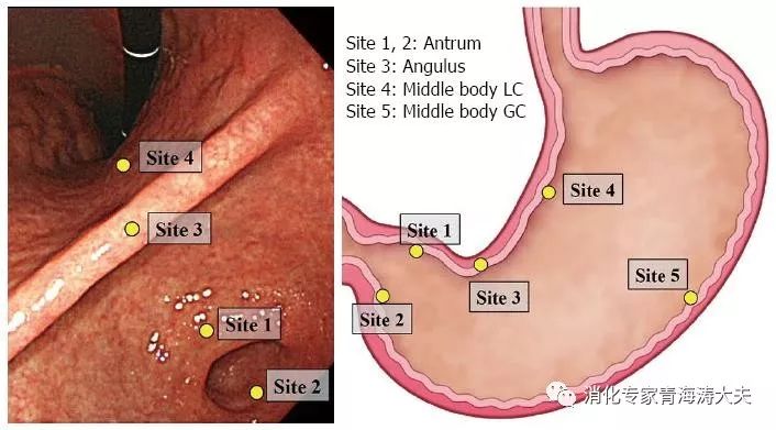 早期胃癌的内镜与fice诊断,胃癌早期的cea是多少