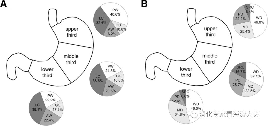 早期胃癌的内镜与fice诊断,胃癌早期的cea是多少