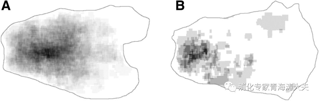 早期胃癌的内镜与fice诊断,胃癌早期的cea是多少