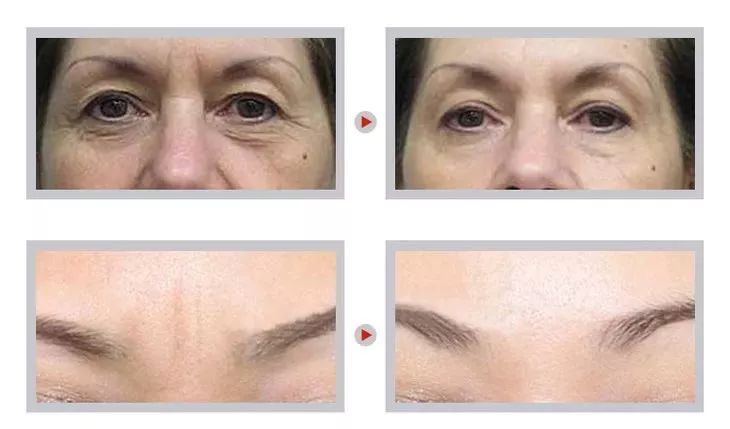 眉间纹抬头纹祛皱效果好吗,祛皱淡纹美容院