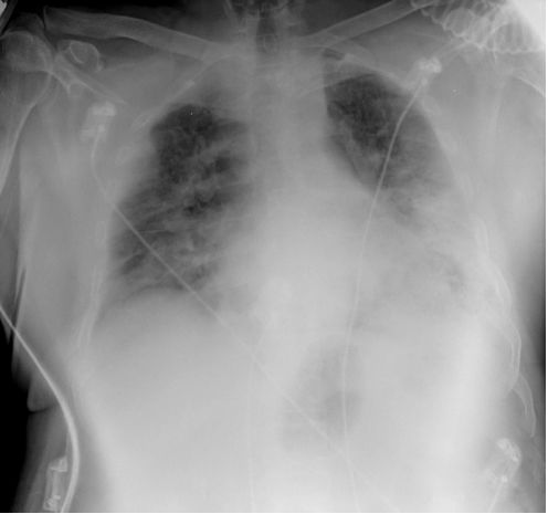 呼吸机通气参数,呼吸机分钟通气量过低原因及处理