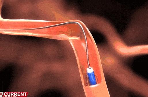 紧急救治脑卒中患者,医院真实脑卒中急救