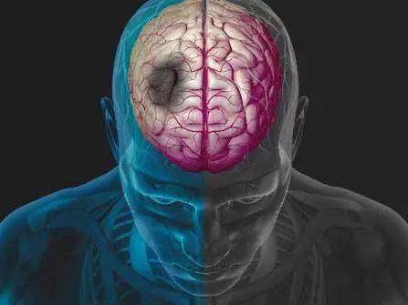 紧急救治脑卒中患者,医院真实脑卒中急救