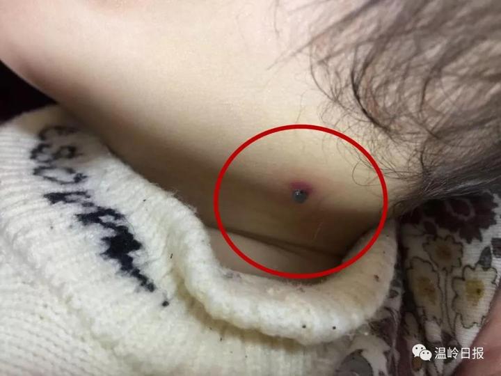 吸血虫钻进手里怎么处理,吸血虫咬着孩子怎么拿掉