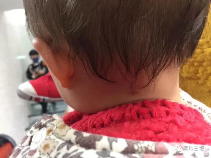 吸血虫钻进手里怎么处理,吸血虫咬着孩子怎么拿掉