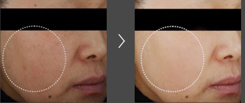 5个祛斑小妙招淡化晒斑雀斑痘印,痘印晒斑和疤痕用什么产品比较好