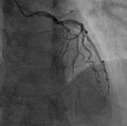 胸痛中心用26分钟救回生命,心肌梗死胸痛中心