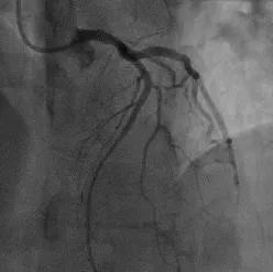 胸痛中心用26分钟救回生命,心肌梗死胸痛中心