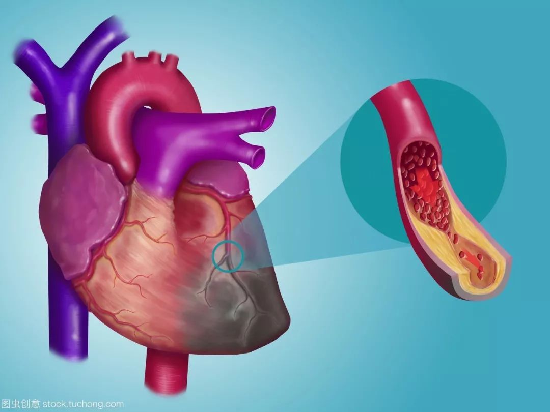 胸痛中心用26分钟救回生命,心肌梗死胸痛中心