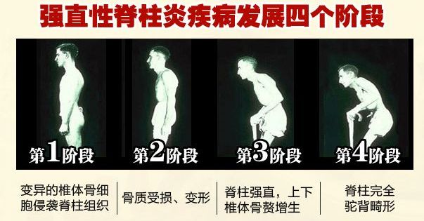 强直性脊柱炎治不好的原因,强直性脊柱炎压缩性骨折特点