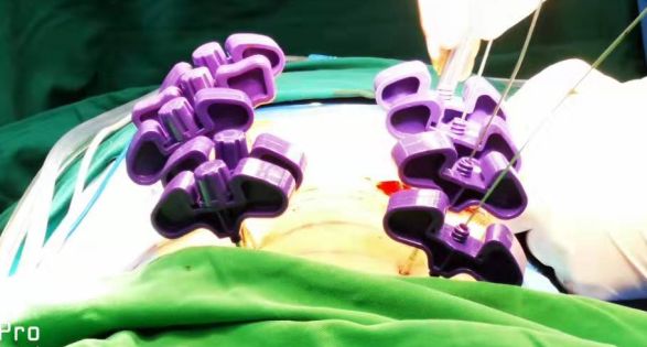 强直性脊柱炎治不好的原因,强直性脊柱炎压缩性骨折特点