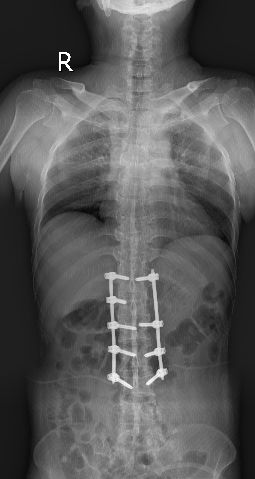 强直性脊柱炎治不好的原因,强直性脊柱炎压缩性骨折特点