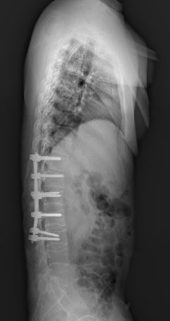 强直性脊柱炎治不好的原因,强直性脊柱炎压缩性骨折特点