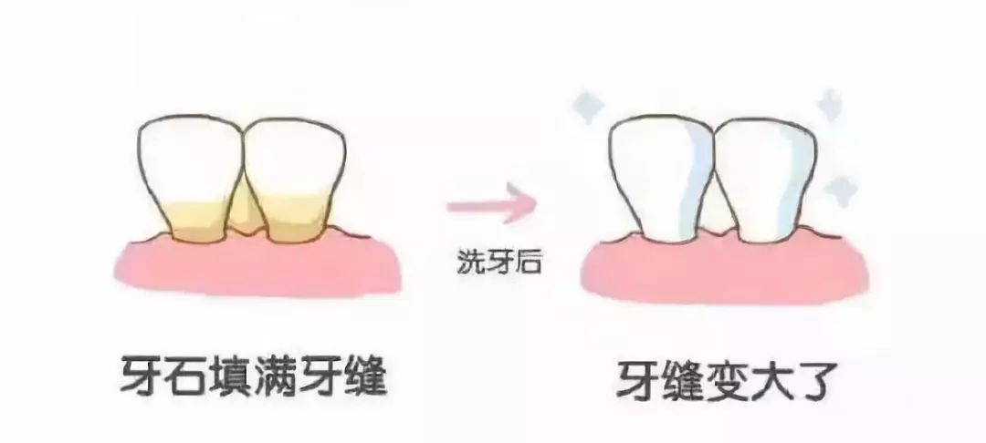 到底应不应该洗牙知乎,应该洗牙抛光吗